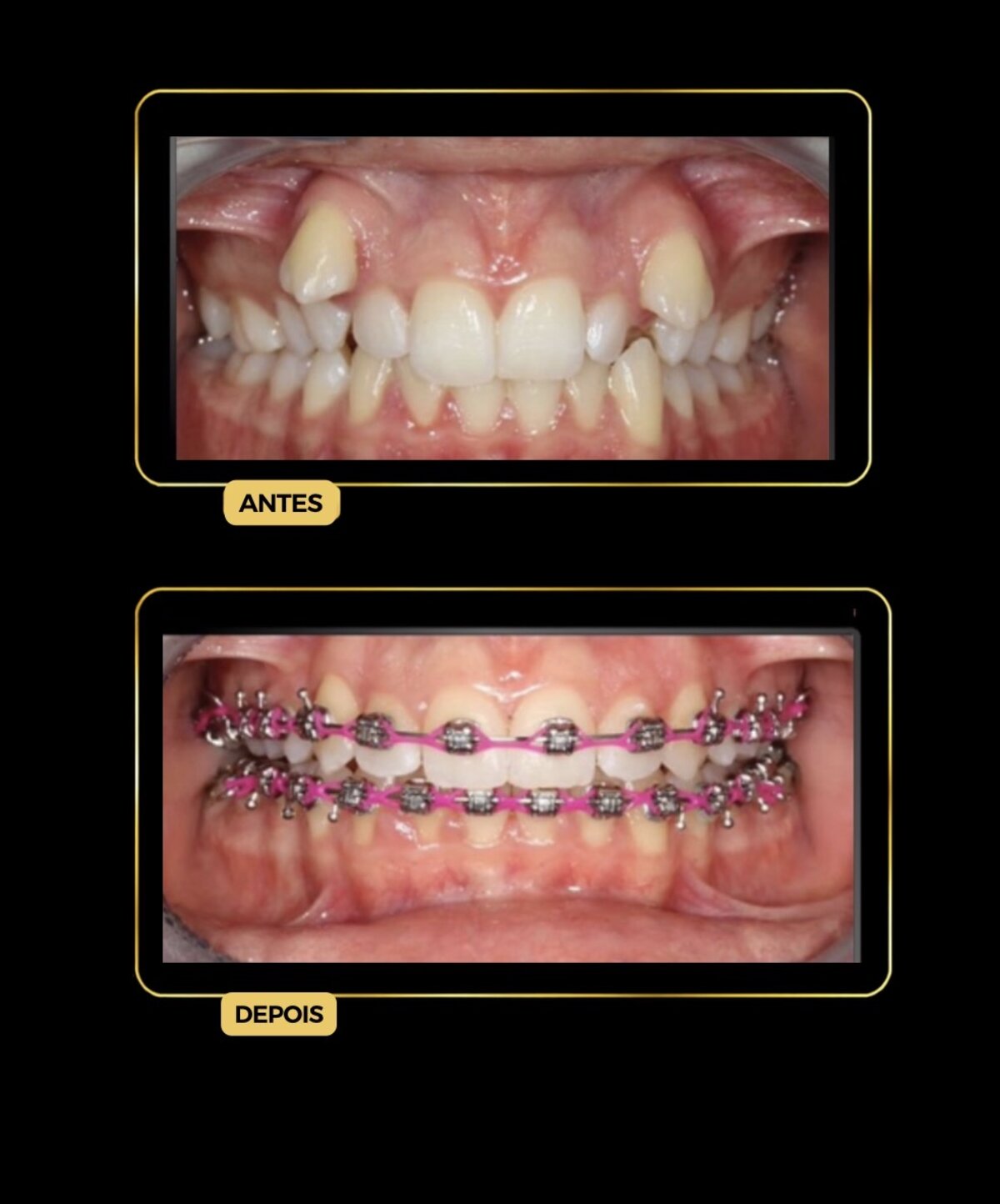 Antes e depois de alinhamento com aparelho ortodôntico fixo — paciente da Odontologia Oliveira