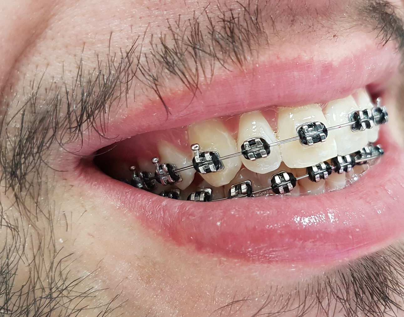 Sorriso com aparelho ortodôntico fixo — paciente da Odontologia Oliveira