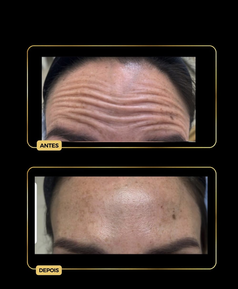 Antes e depois — botox