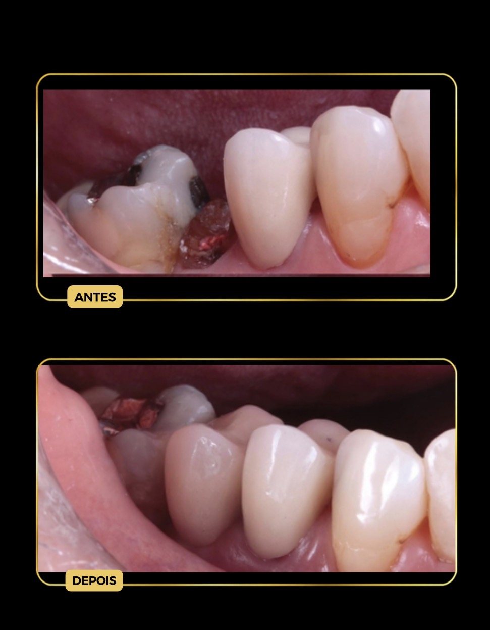 Antes e depois — coroa / prótese fixa