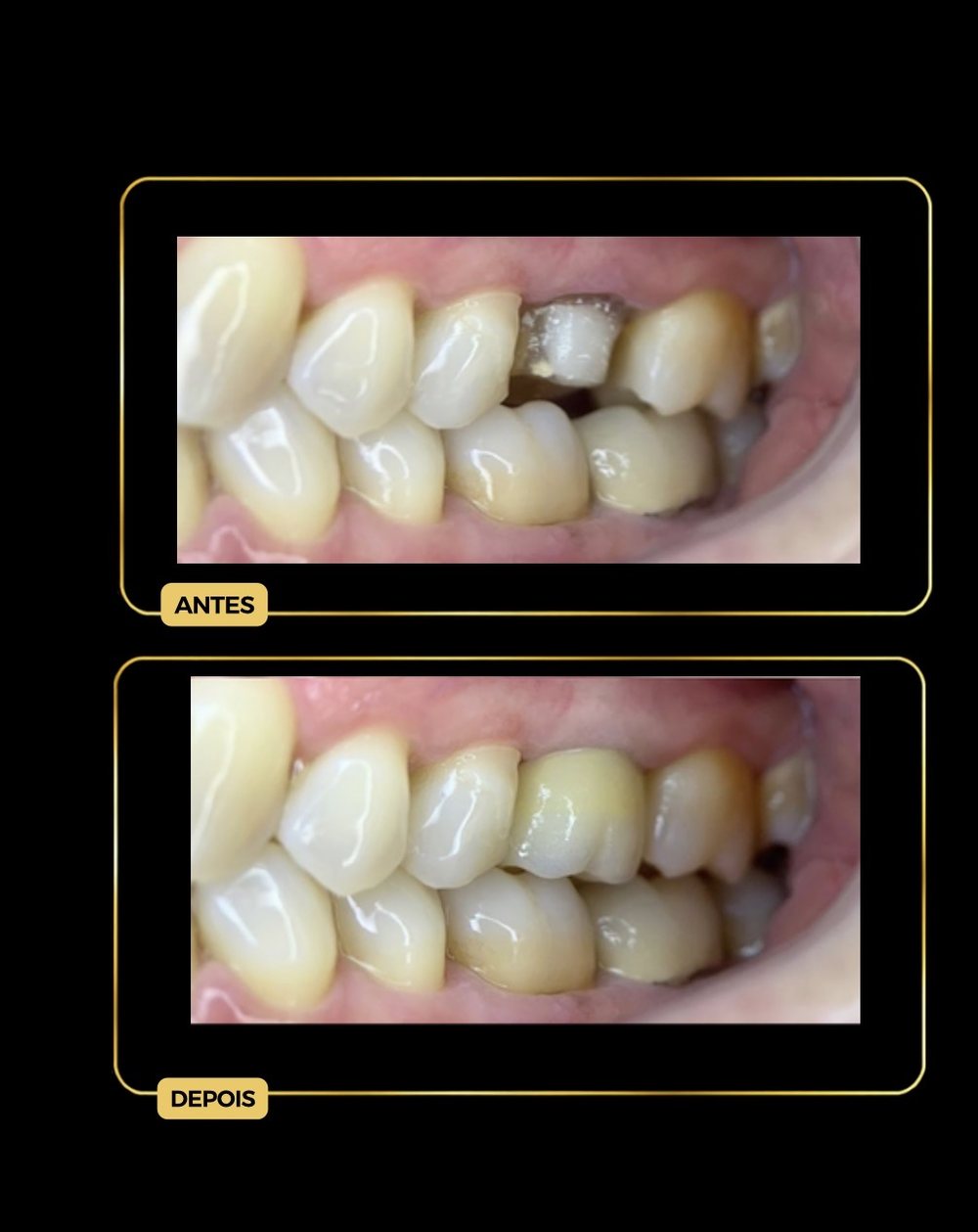Antes e depois — coroa / prótese fixa