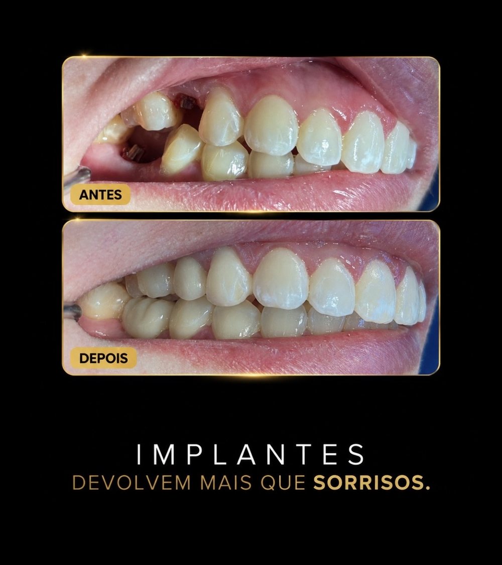 Antes e depois — implante unitário