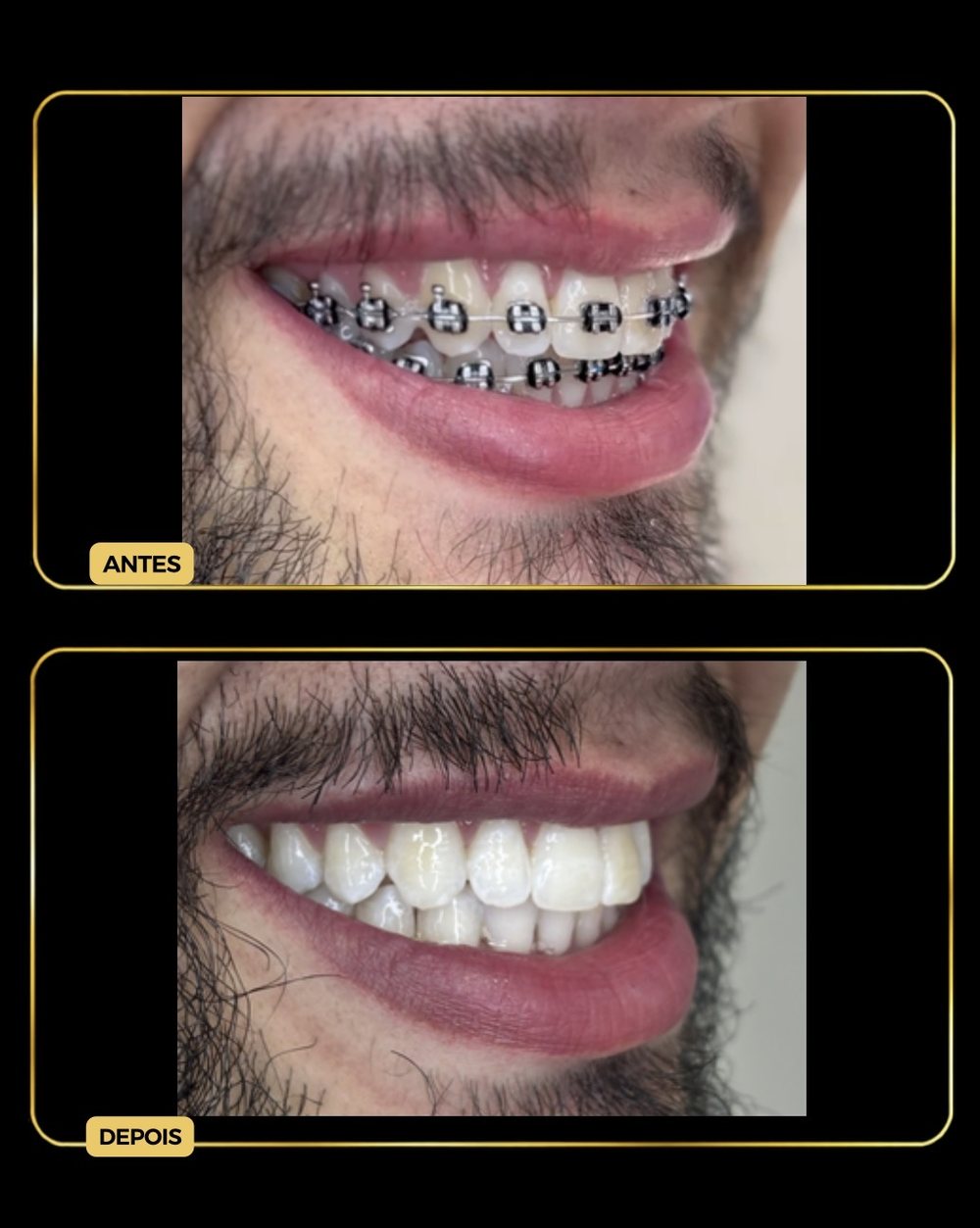 Antes e depois — aparelho ortodôntico