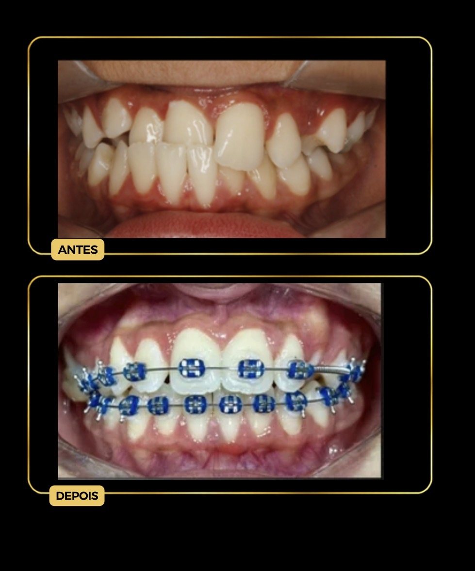 Antes e depois — aparelho ortodôntico