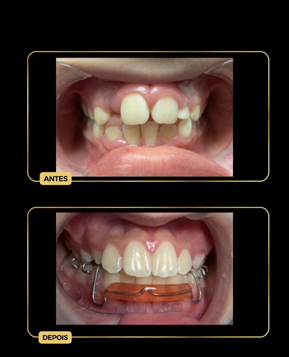 Antes e depois — ortopedia facial