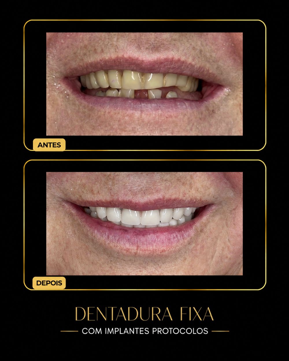 Antes e depois — dentadura fixa com protocolo