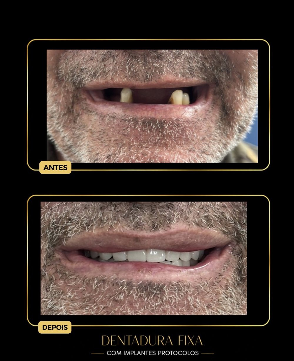 Antes e depois — dentadura fixa com protocolo