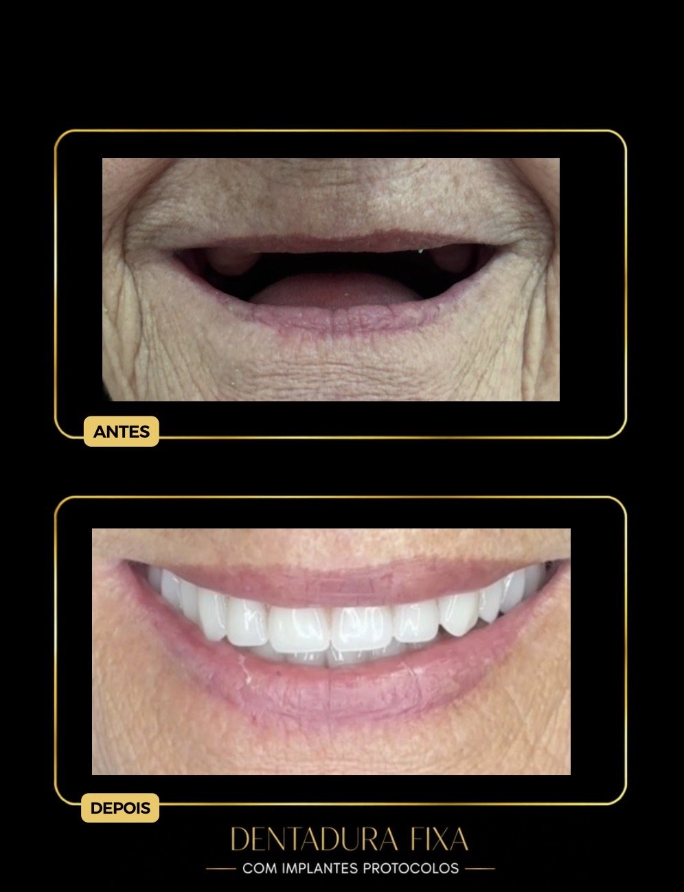 Antes e depois — dentadura fixa com protocolo