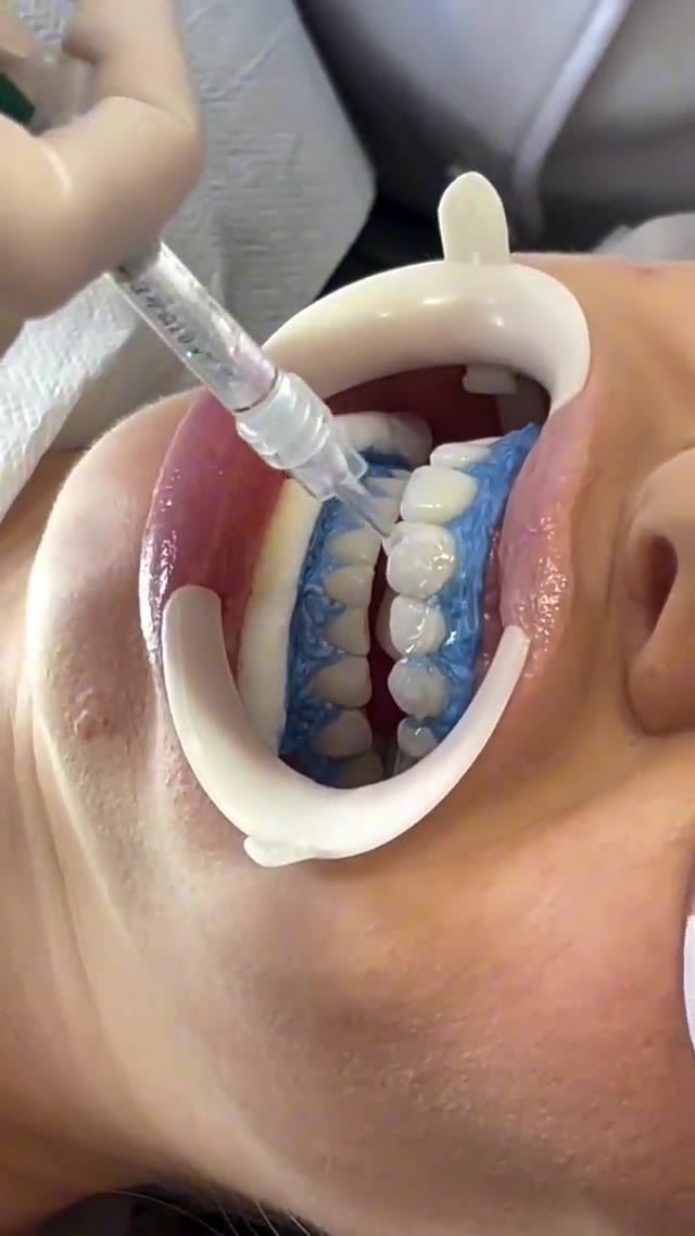 Aplicação do gel clareador nos dentes — atendimento na Odontologia Oliveira