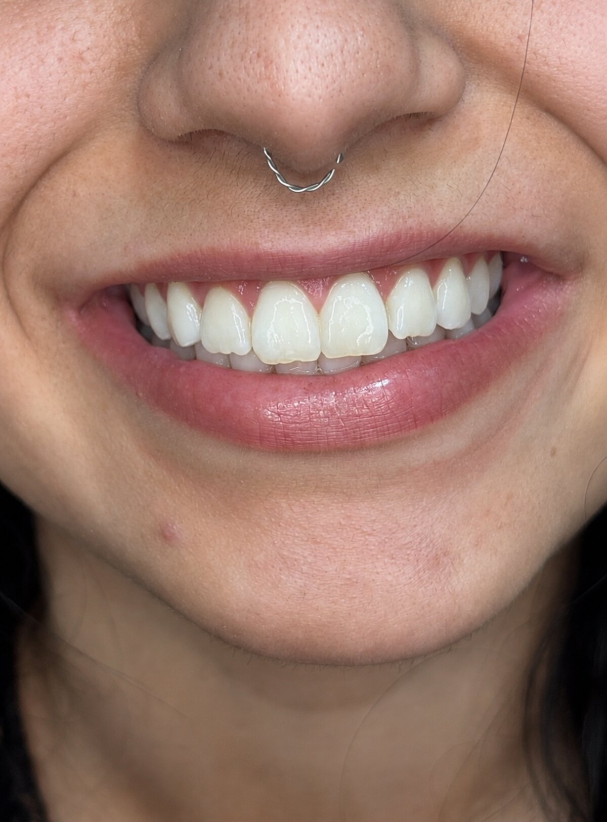 Sorriso após clareamento dental — paciente da Odontologia Oliveira