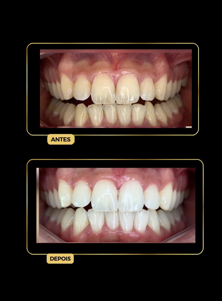 Antes e depois de clareamento dental — paciente da Odontologia Oliveira