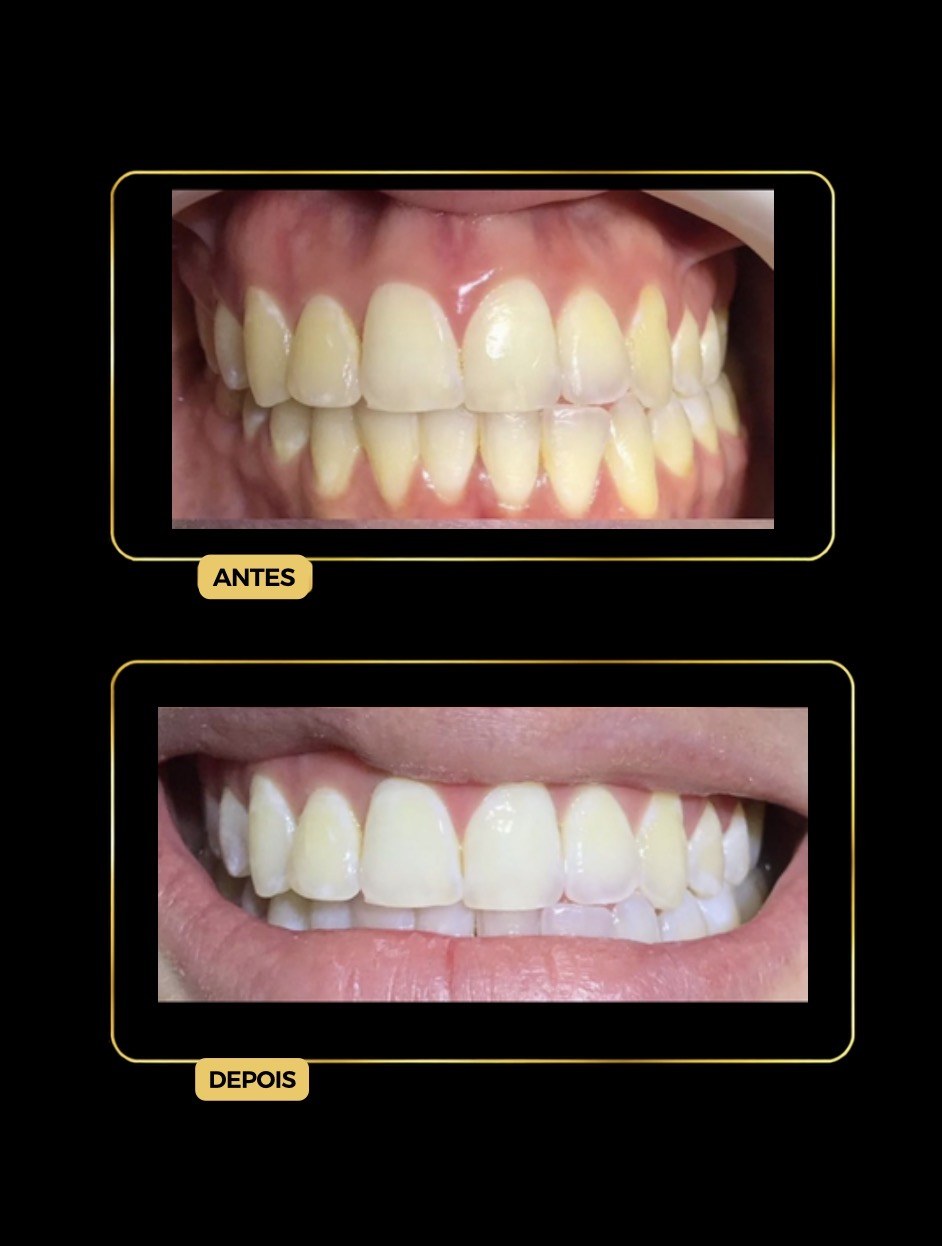 Antes e depois de clareamento dental — paciente da Odontologia Oliveira