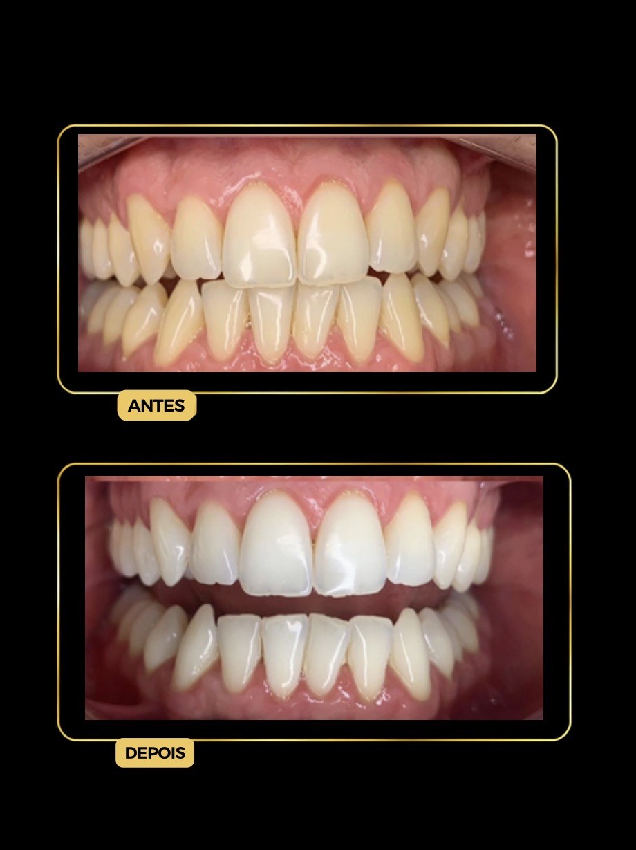 Antes e depois de clareamento dental — paciente da Odontologia Oliveira
