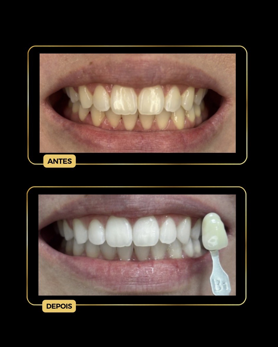 Antes e depois de clareamento dental — paciente da Odontologia Oliveira