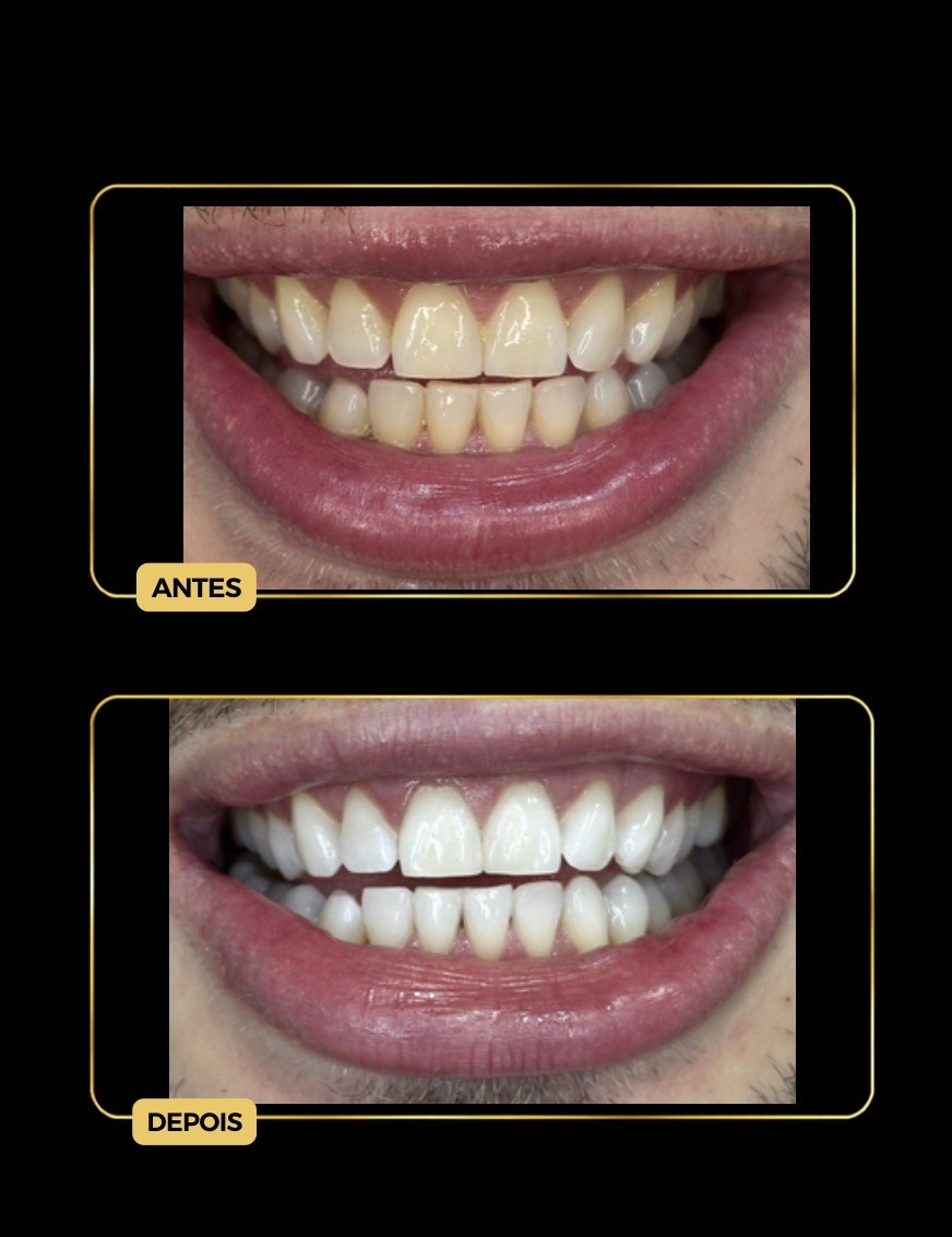 Antes e depois de clareamento dental — paciente da Odontologia Oliveira