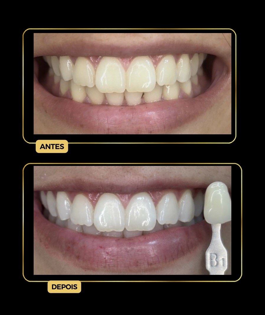 Antes e depois de clareamento dental — paciente da Odontologia Oliveira