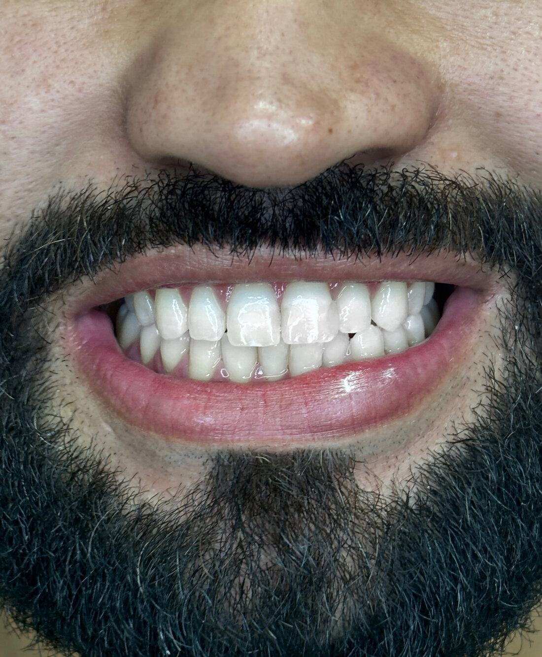 Sorriso natural após clareamento dental — paciente da Odontologia Oliveira