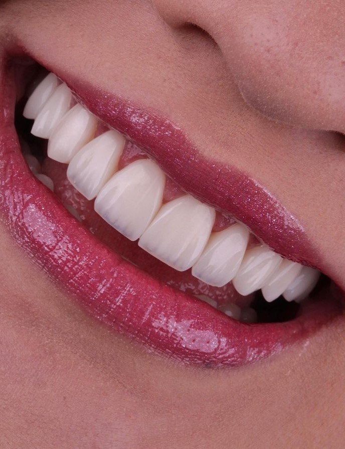 Sorriso com facetas dentárias — paciente da Odontologia Oliveira