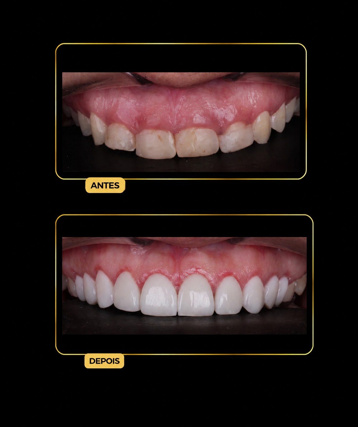 Antes e depois de facetas dentárias — paciente da Odontologia Oliveira