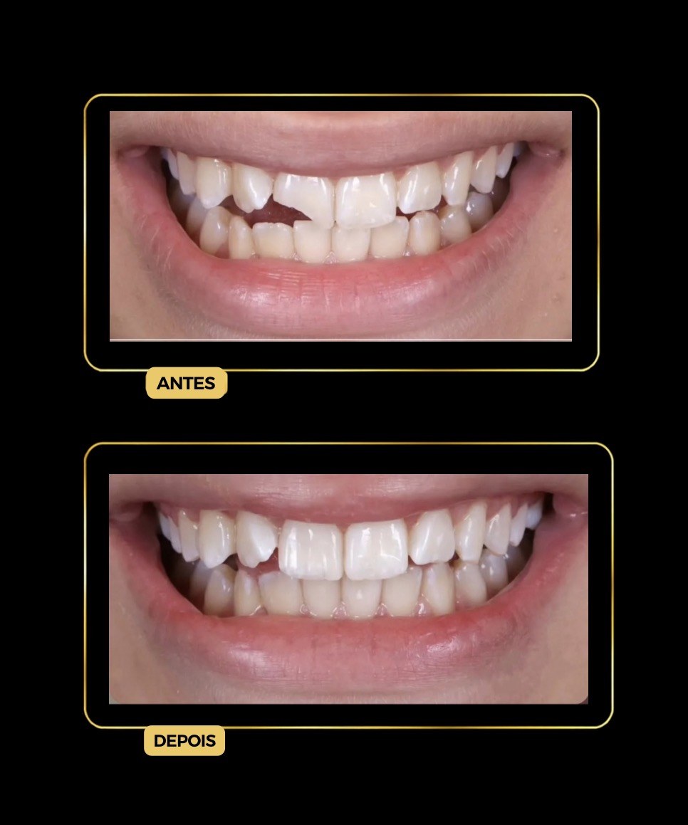 Antes e depois de facetas dentárias — paciente da Odontologia Oliveira