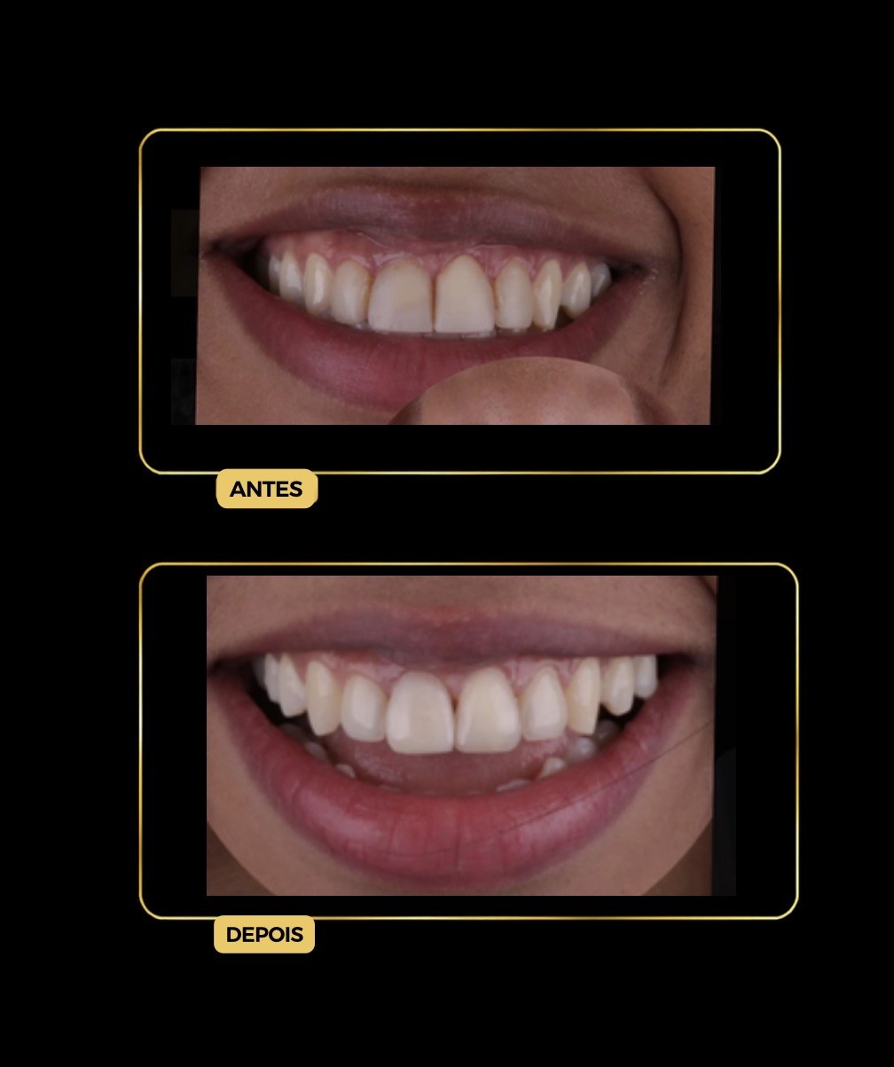 Antes e depois de facetas dentárias — paciente da Odontologia Oliveira