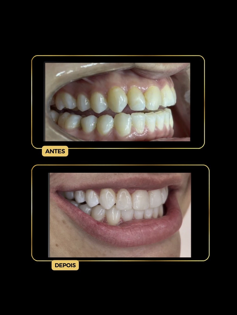 Antes e depois de facetas dentárias — paciente da Odontologia Oliveira