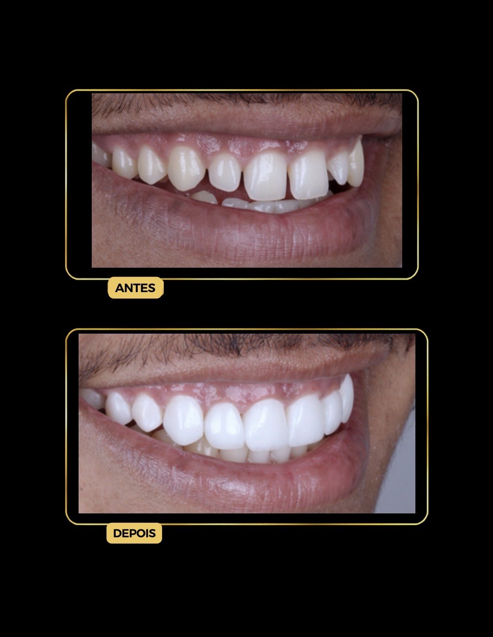Antes e depois de facetas dentárias — paciente da Odontologia Oliveira