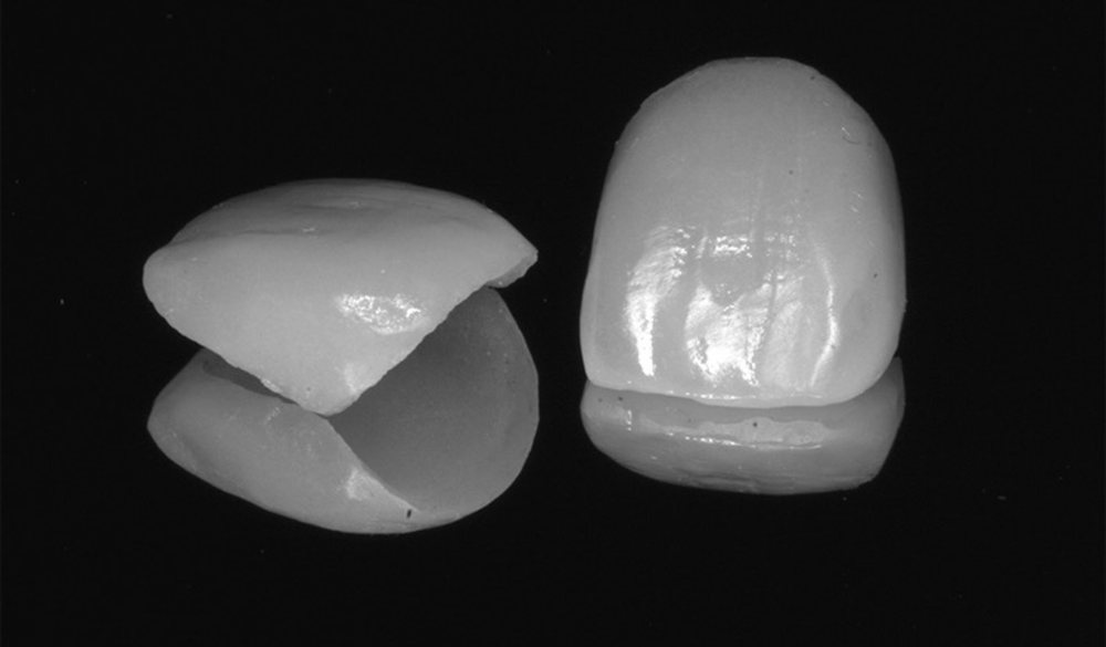 Facetas de cerâmica — Odontologia Oliveira