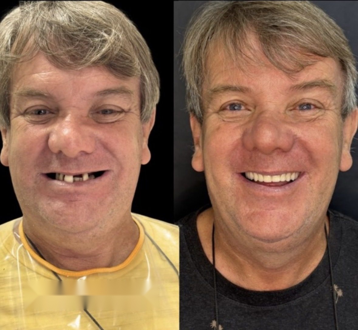 Antes e depois de reabilitação com prótese sobre implantes dentários - paciente Cobi, Odontologia Oliveira