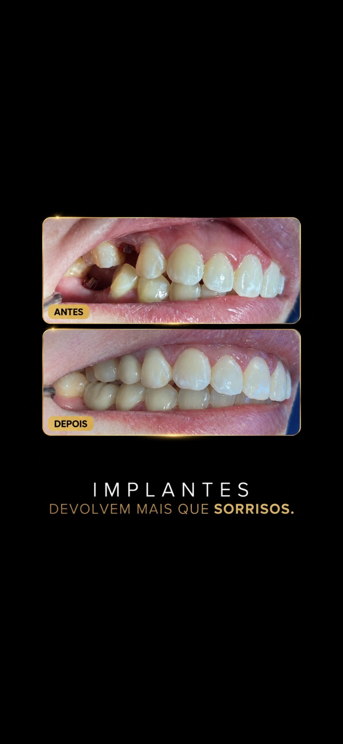 Antes e depois de reabilitação com implantes dentários