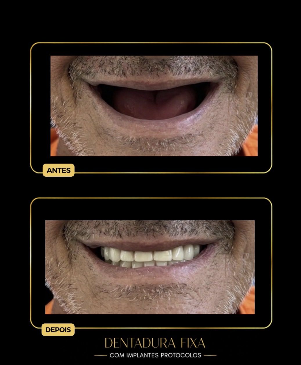 Antes e depois de protocolo sobre implantes dentários