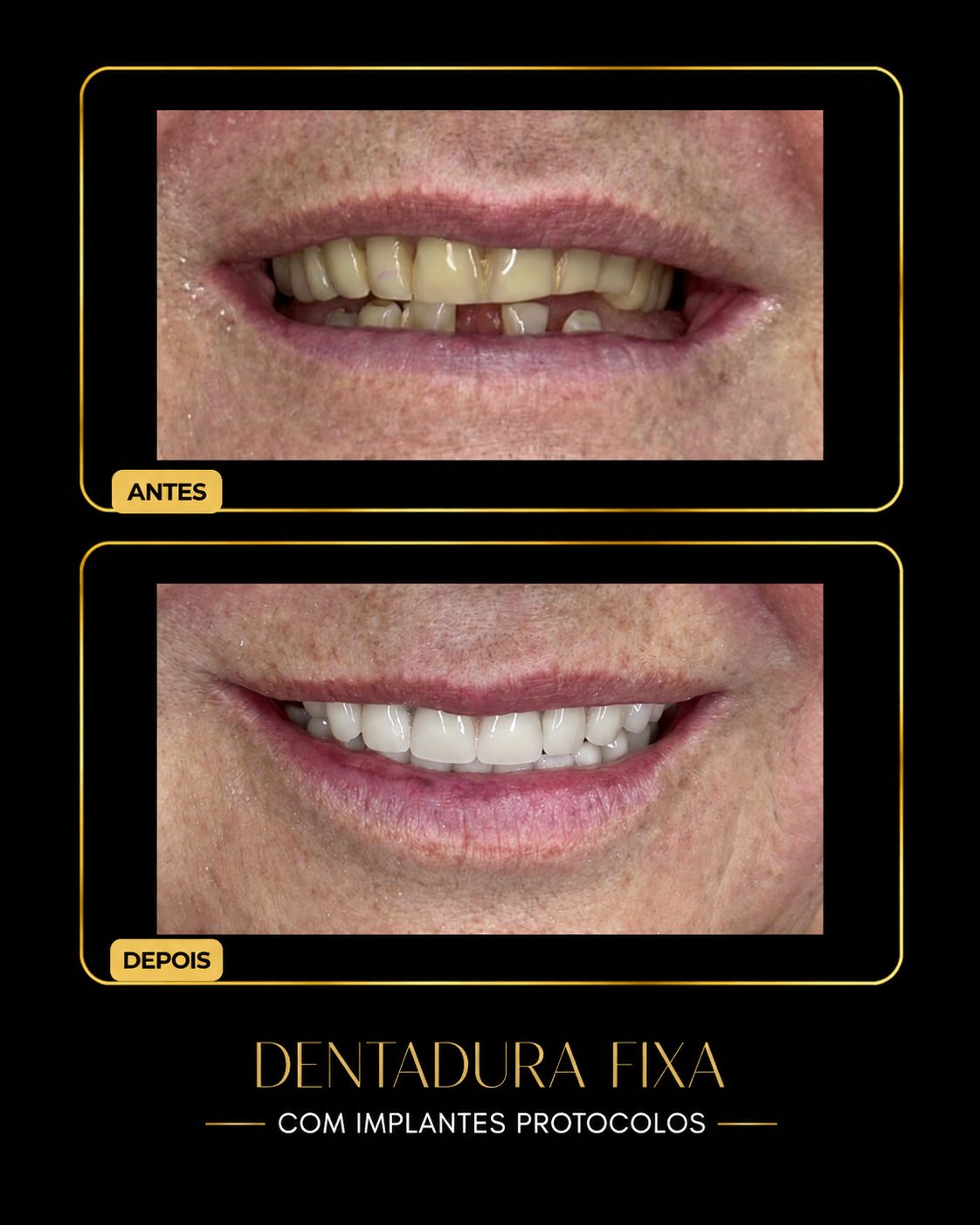 Antes e depois de dentadura fixa sobre implantes dentários