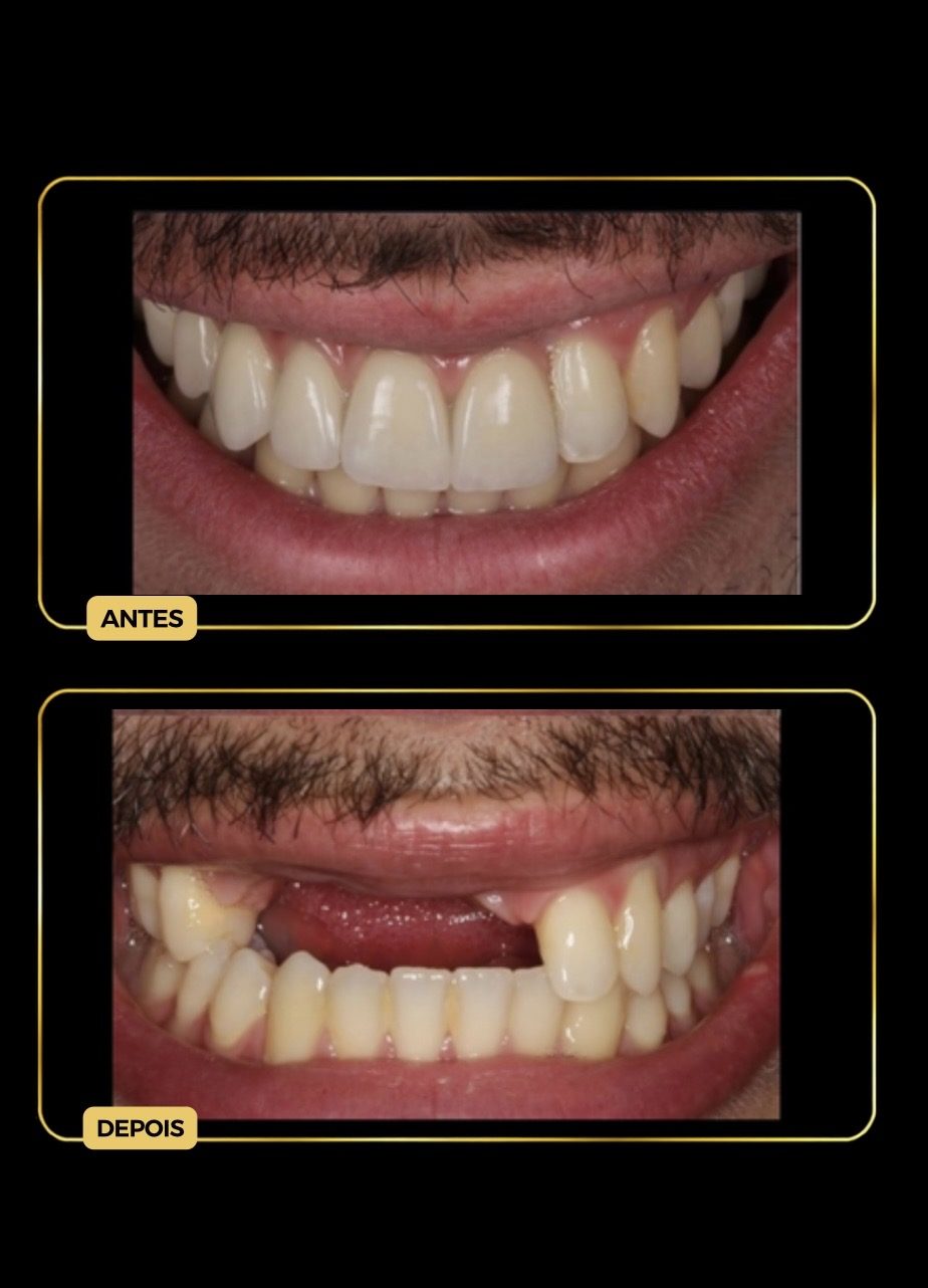 Antes e depois de dentadura fixa sobre implantes dentários
