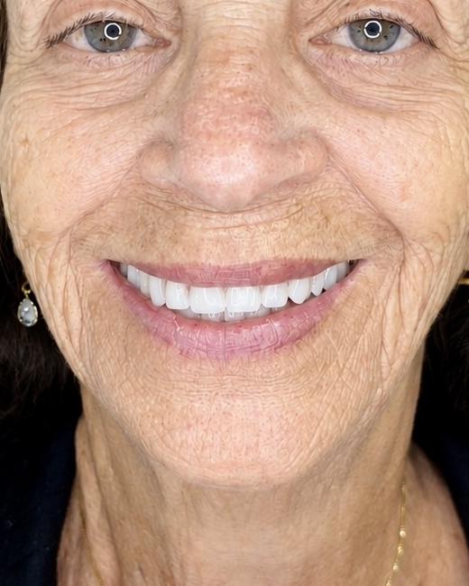Paciente sorrindo com resultado de reabilitação com implantes dentários - Odontologia Oliveira, Pouso Alegre