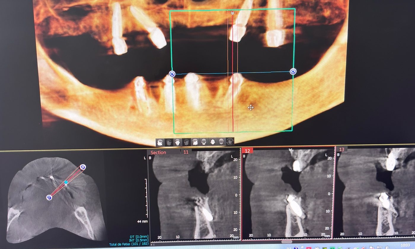 Tomografia utilizada na avaliação e planejamento de caso de implante dentário