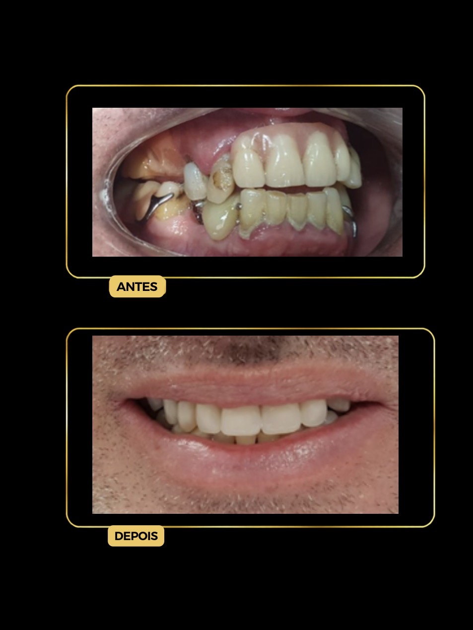 Antes e depois — prótese parcial removível (ponte móvel)