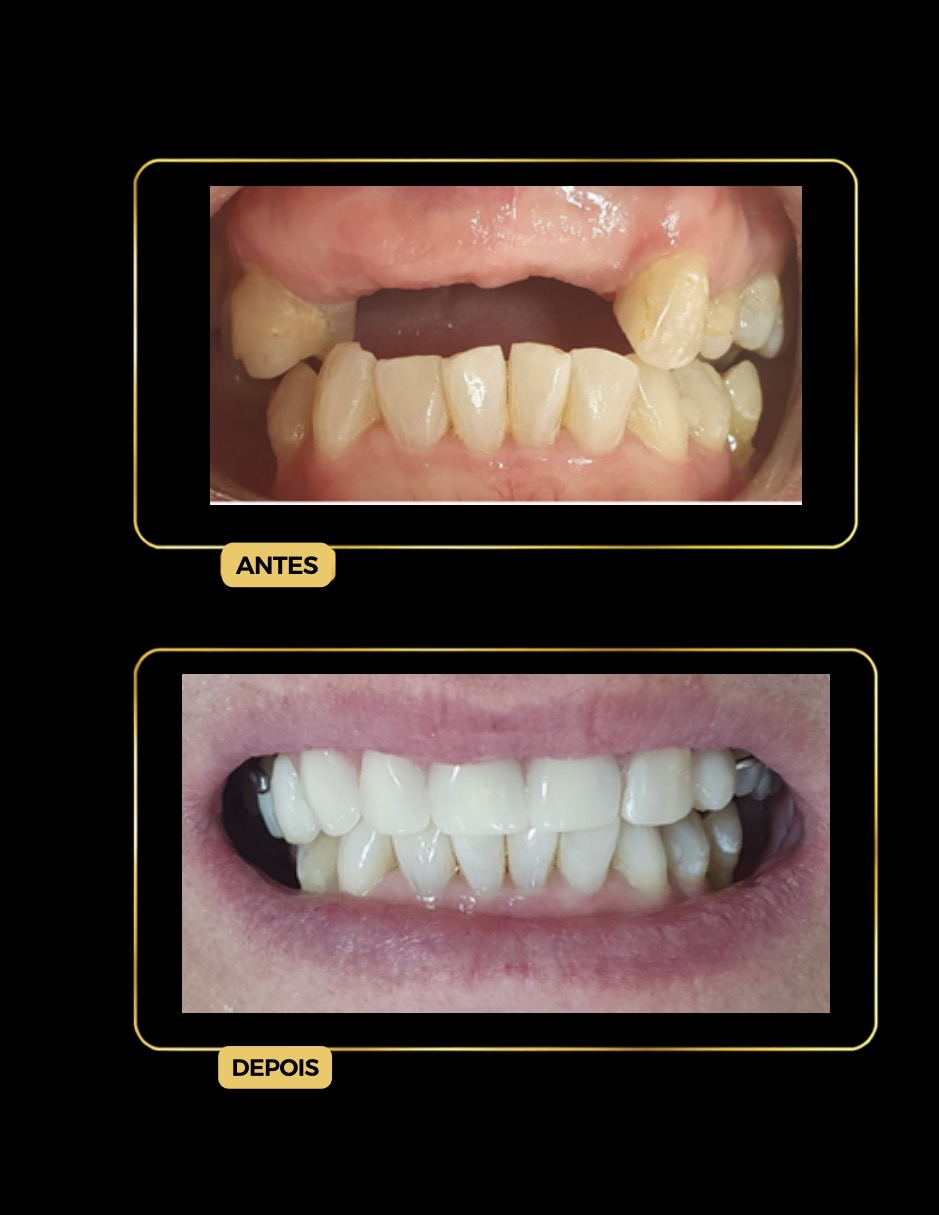 Antes e depois — prótese parcial removível (ponte móvel), dente único