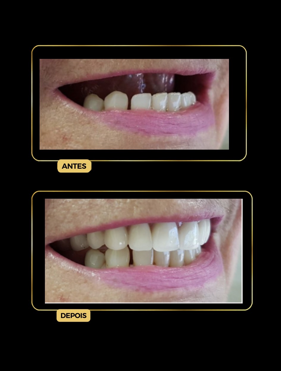 Antes e depois — prótese total (dentadura), arcada superior