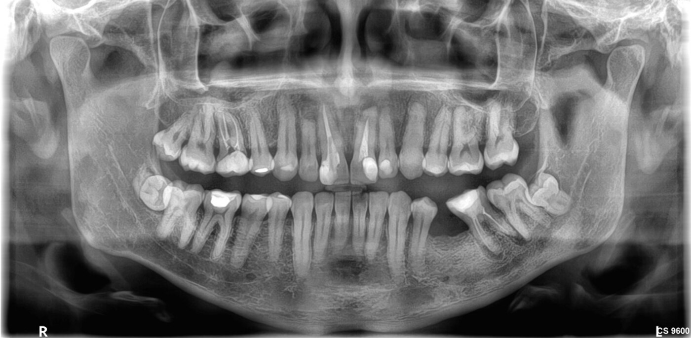 Radiografia panorâmica utilizada na avaliação de siso na Odontologia Oliveira